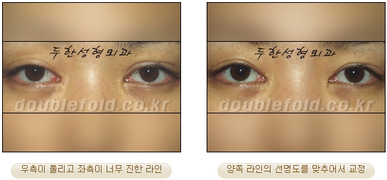 [두한성형외과 쌍커풀수술] - [눈성형 방법에 대한 자주하는 질문과 답변] 관련 이미지 39