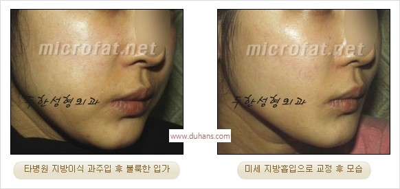 [두한성형외과 경쟁력 윤곽성형] - [볼, 볼살 지방이식] 관련 이미지 43