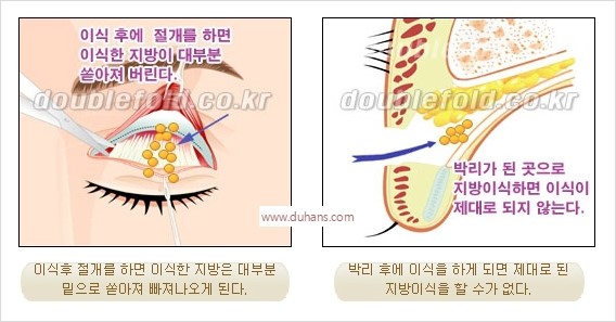 [두한성형외과 경쟁력 쌍꺼풀 재수술 리더] - [풀린 쌍꺼풀, 풀려버린 쌍꺼풀 재수술 방법 안내] 관련 이미지 1
