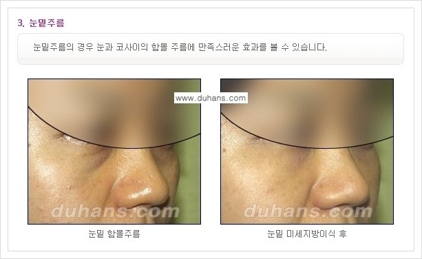 ​[두한성형외과 경쟁력 주름성형] - [주름교정을 위한 미세지방이식 안내 1.] 관련 이미지 16