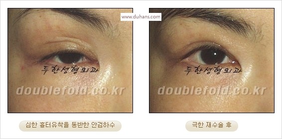 [두한성형외과 경쟁력 쌍꺼풀 재수술 스페셜] - [망가진 라인을 교정하는 극한 재수술] 관련 이미지 19