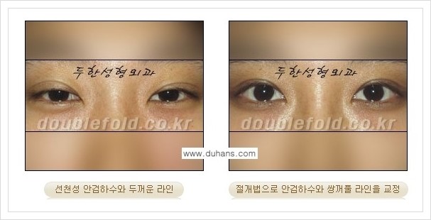 [두한성형외과 경쟁력 쌍꺼풀 재수술, 극한 눈 재수술] - [안검하수(졸리운 눈매) 재수술 안내] 관련 이미지 2