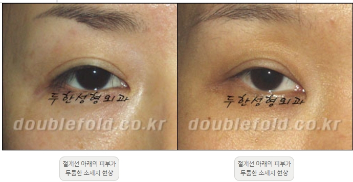 [Double Eyelid Surgery Duhan Plastic Surgery] - [Revision Methods] image 12