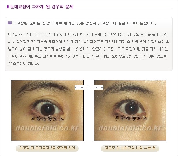 [두한성형외과 경쟁력 쌍꺼풀 재수술, 극한 재수술] - [쌍꺼풀 재수술, 극한 재수술 시 문제점 안내] 관련 이미지 9