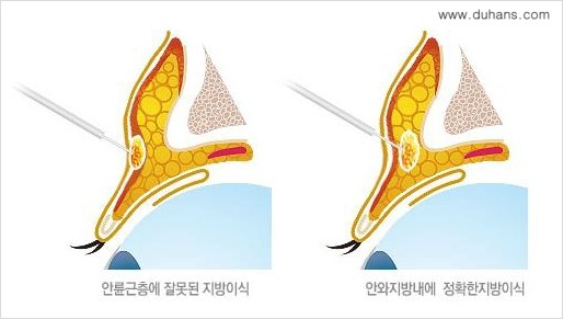 [두한성형외과 무한 경쟁력 다크써클 치료] - [다크써클 + 눈위 지방이식 콤비 프로그램] 관련 이미지 4