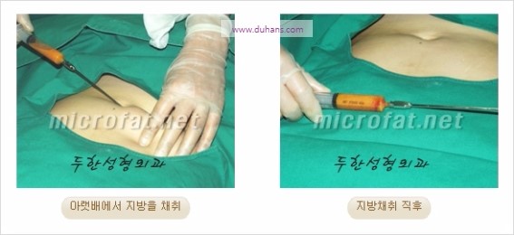 [두한성형외과 경쟁력 눈밑성형] - [눈밑애교살 필러 시술의 부작용 교정 방법] 관련 이미지 6