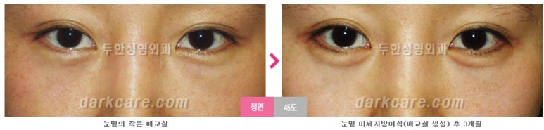 [두한성형외과 다크서클] - [다크서클 전후사진 검증] 관련 이미지 50