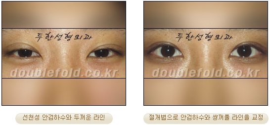 [Duhan Plastic Surgery Secondary Double Eyelid Surgery] - [Sleepy Eye Appearance, Asymmetrical Eye Appearance, Ptosis] image 13