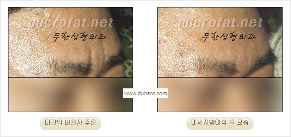 [두한성형외과 경쟁력 동안성형 리더] - ​[미간주름, 이마주름, 안검성형, 이마거상술, 눈썹거상술] 관련 이미지 9