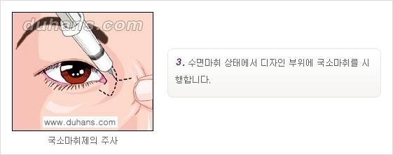 [두한성형외과 NO.1 눈성형] - [몽고주름 제거(앞트임 수술) 2.] 관련 이미지 4