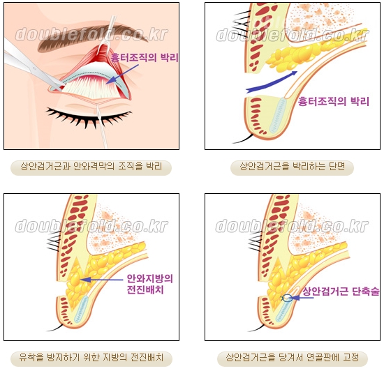 [Eye Surgery, Duhan Plastic Surgery] - [Revision Surgery for a Thick Double-Eyelid Line] image 7