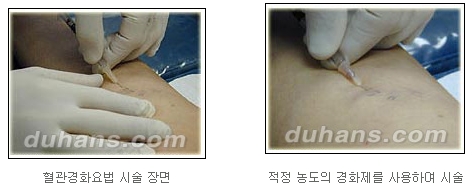 [두한성형외과 정맥류] - [정맥류 시술안내] 관련 이미지 9