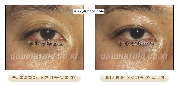[두한성형외과 경쟁력 눈성형] - [삼중(세겹) 쌍꺼풀 라인의 교정] 관련 이미지 17