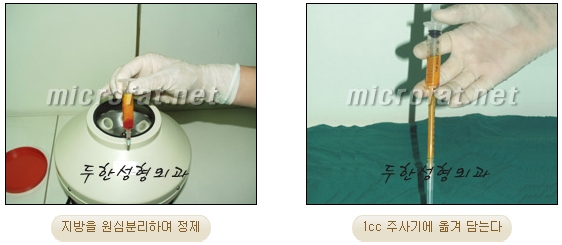 [Doohan Plastic Surgery Autologous Fat Grafting] - [Sunken Eye Fat Grafting] image 7
