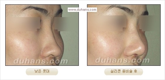 [두한성형외과 경쟁력 코성형] - [코성형을 위한 알로덤(슈어덤) 수술, 실리콘 수술 안내] 관련 이미지 29