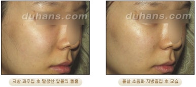 [두한성형외과 안전한 지방흡입] - [얼굴지방흡입] 관련 이미지 29