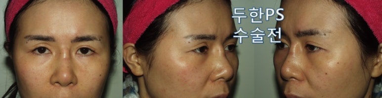 [두한성형외과-쌍꺼풀재수술 & 이마,팔자,눈밑,인디언밴드 지방이식] 관련 이미지 1