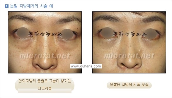 [두한성형외과 경쟁력 "지방제거"] - [눈 지방제거 2.] 관련 이미지 9