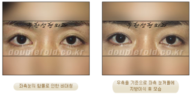 [Duhan Plastic Surgery Eye Surgery] - [Asymmetric Line, Eyelash Eversion, Deep Fixation] image 20