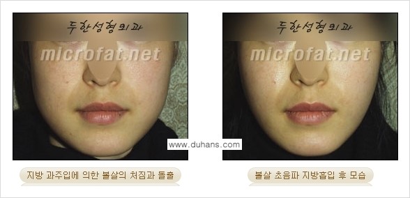 ​[두한성형외과 가을엔 지방흡입을] - [볼살, 눈밑, 턱선 초음파 미세지방흡입] 관련 이미지 6