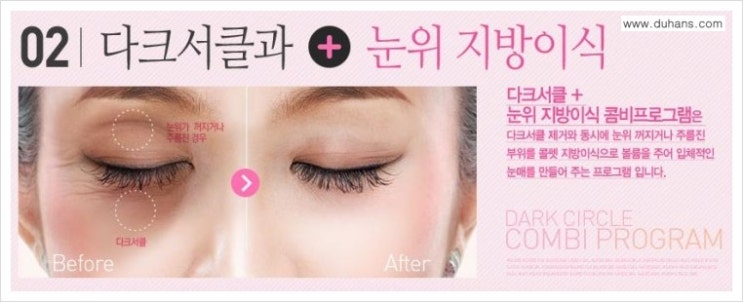 [두한성형외과 무한 경쟁력 다크써클 치료] - [다크써클 + 눈위 지방이식 콤비 프로그램] 관련 이미지 1