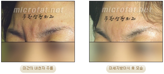 [두한성형외과 자가지방이식] - [미간주름] 관련 이미지 7