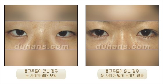 [DuHan Plastic Surgery Eye Surgery] - [Guide to Epicanthoplasty and Canthoplasty for Increasing the Horizontal Width of the Eyes] image 8
