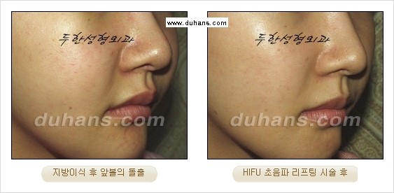 [두한성형외과 경쟁력 주름성형] - [주름제거를 위한 리프팅] 관련 이미지 48