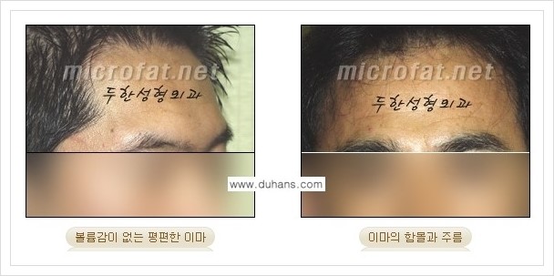 [두한성형외과 경쟁력 미세지방이식] - [부드럽고 아름다운 얼굴 윤곽선 이마(전두부) 미세지방이식] 관련 이미지 2