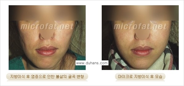 [두한성형외과 경쟁력 미세지방이식] - [지방이식 부작용 - 지방이식 후 발생한 굴곡현상에 대한 안내] 관련 이미지 4