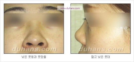 [두한성형외과 경쟁력 코성형] - [코를 높히는 지방이식] 관련 이미지 3