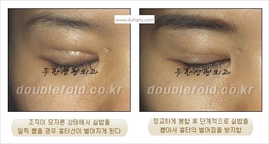 [두한성형외과 경쟁력 눈성형] - [쌍꺼풀 재수술 실패의 원인과 문제점] 관련 이미지 11