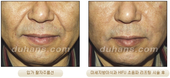 [Duhan Plastic Surgery Lift] - [Double Chin, Drooping Cheeks, Sagging Neck Skin, Wrinkle Improvement] image 29