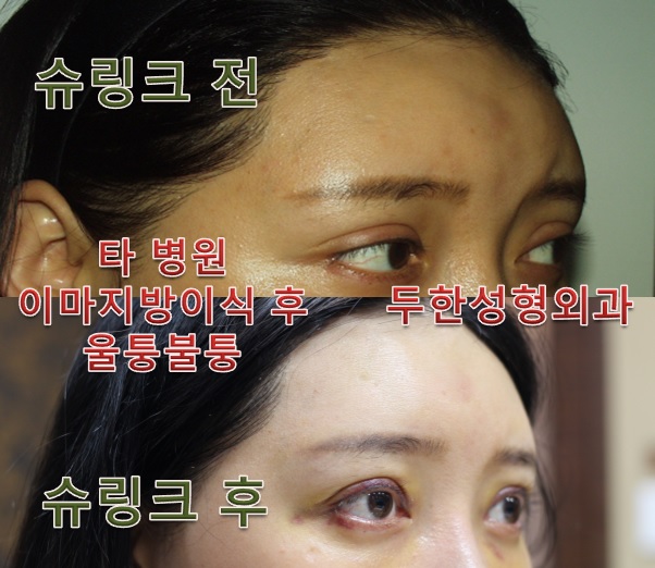 [두한성형외과 쌍꺼풀재수술, 이마슈링크]-[#라인낮추기 #소세지개선 #이마슈링크 #울퉁불퉁한이마개선] 관련 이미지 4