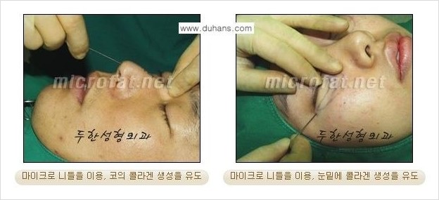 [두한성형외과 경쟁력 지방이식] - [두한 자가지방이식 클리닉 안내]​ 관련 이미지 32