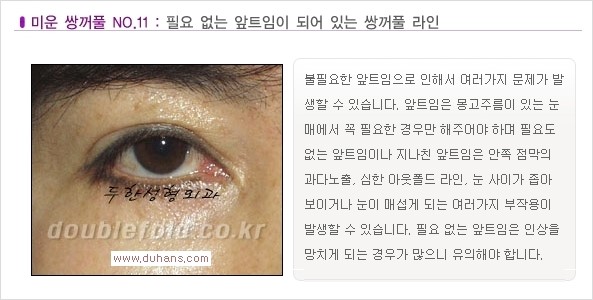[두한성형외과 경쟁력 눈성형] - [나에게 맞는 맞춤 쌍꺼풀 찾기] 관련 이미지 11
