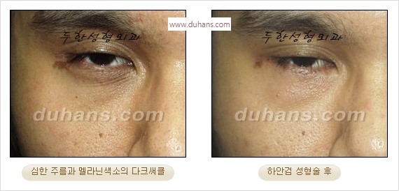 [두한성형외과 경쟁력 안검성형] - [눈밑주름 제거수술] 관련 이미지 15