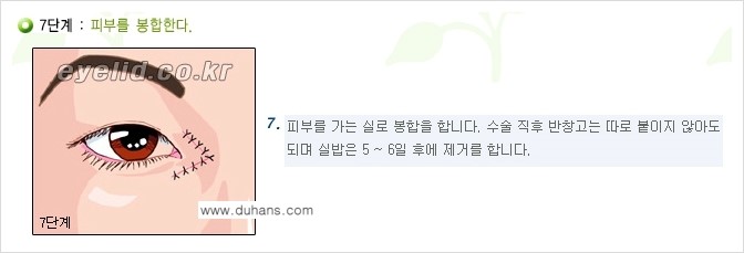 [두한성형외과 눈성형 FOCUS] - [몽고주름 제거(앞트임 제거) 수술 ③] 관련 이미지 10