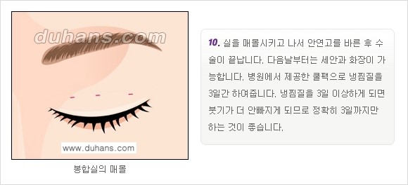 [두한성형외과 경쟁력 눈성형]- [최소 부기로 일상의로의 복귀가 가능한 아름다운 퀵쌍꺼풀(부분절개법) 수술] 관련 이미지 10
