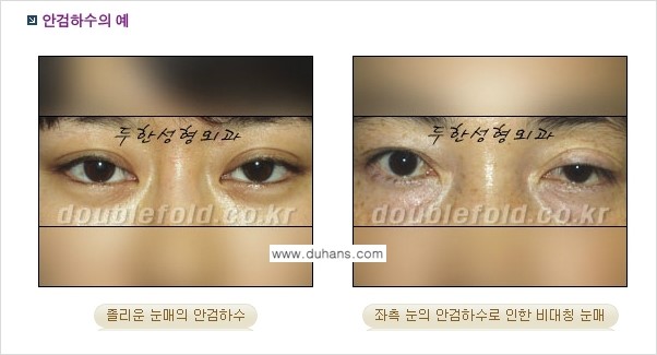 [두한성형외과 NO.1 "극한 눈(쌍꺼풀 재수술)"] - [안검하수(졸린눈매) 재수술 안내 1.] 관련 이미지 2