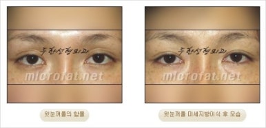 [두한성형외과 얼굴자가지방이식] - [지방이식 과정] 관련 이미지 28