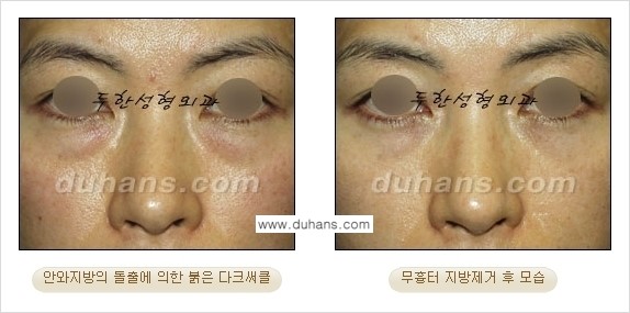 [두한성형외과 젊은 눈매 안검성형] - [눈밑 지방제거의 수술 전후 안내 ①] 관련 이미지 10