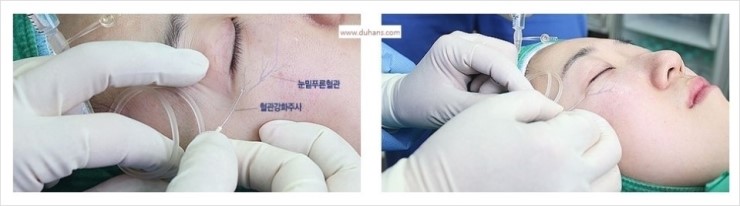 [두한성형외과 경쟁력 눈밑성형] - [다크써클의 모든 것] 관련 이미지 36