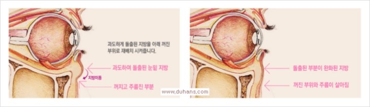 ​[두한성형외과 경쟁력 눈밑성형 리더] - [눈밑 다크써클의 증상, 원인, 종류, 치료방법 안내] 관련 이미지 49