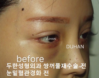 [Duhan Plastic Surgery Double Eyelid Revision Surgery] - [Asymmetric Eye Correction, Thick Ptosis, Lateral and Lower Canthoplasty] image 43