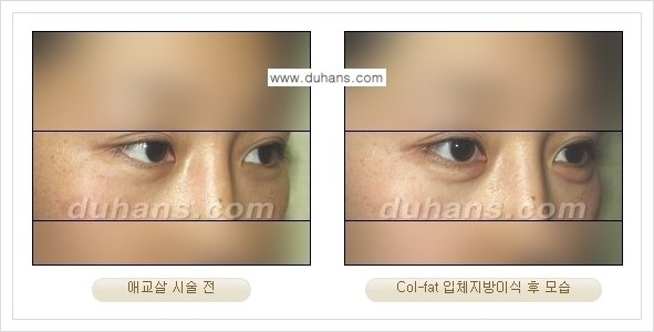 [두한성형외과 경쟁력 미세지방이식] - [지방이식 특허 Col-fat 미세지방이식 성공사례 안내] 관련 이미지 8