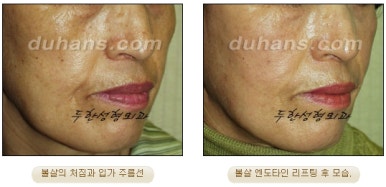 [Duhan Plastic Surgery Wrinkle Improvement] - [Wrinkle Lifting] image 23