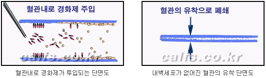 두한성형외과 보기싫은 혈관제거 - 눈밑혈관, 손과 팔의 혈관확장증 치료 관련 이미지 27