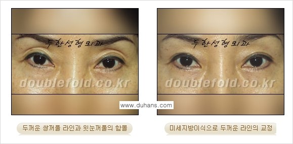 [두한성형외과 NO.1 눈성형] - [함몰된(꺼진) 눈꺼풀에서 쌍꺼풀 라인 교정 2.] 관련 이미지 8