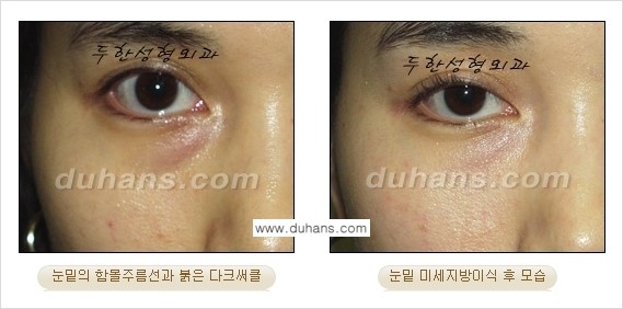 [두한성형외과 상큼하고 환한 눈매완성] - [눈밑 미세지방이식 ②] 관련 이미지 9